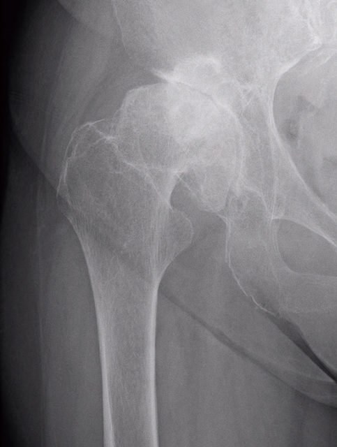 変形性股関節症のレントゲン