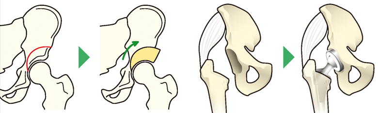 骨切り術（左）と人工股関節置換術（右）