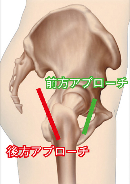 川崎舎 俊一 先生 人工股関節置換術後の生活 リハビリ 人工股関節は 若い患者さんからご高齢の患者さんにも向いている手術 整形外科を受診して 自分にあった情報を手に入れてください 人工関節ドットコム