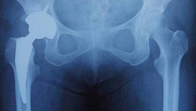 人工股関節置換術後のレントゲン