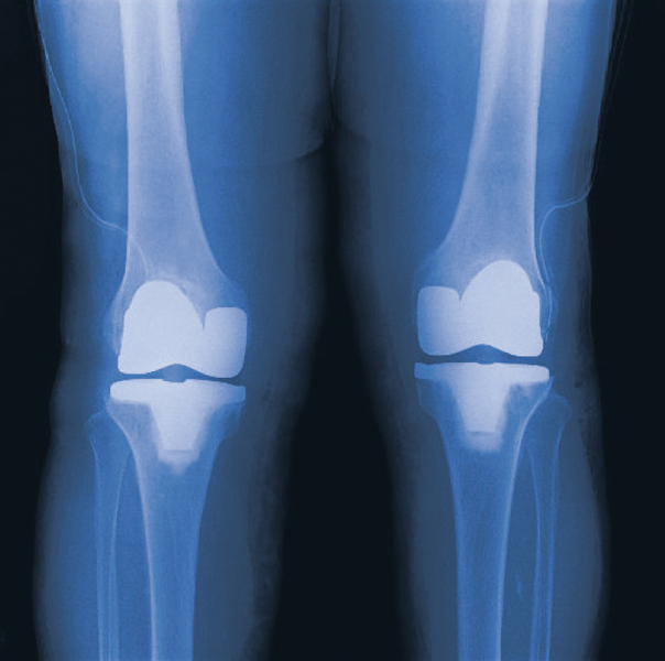 人工膝関節全置換術後のレントゲン