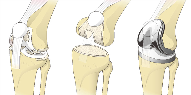 人工膝関節全置換術