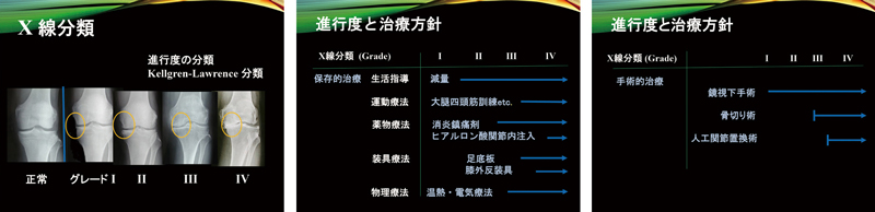 変形性膝関節症の分類