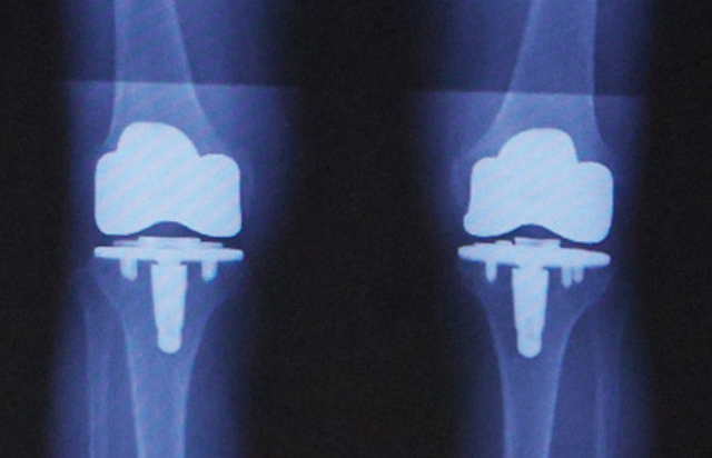人工膝関節全置換術後のレントゲン（両側）