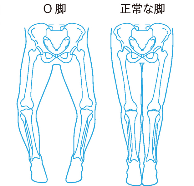 O脚と正常な脚　イラスト