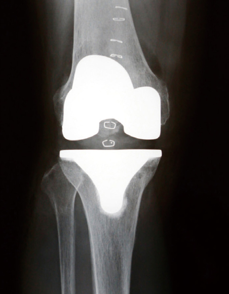 人工膝関節全置換術後のレントゲン