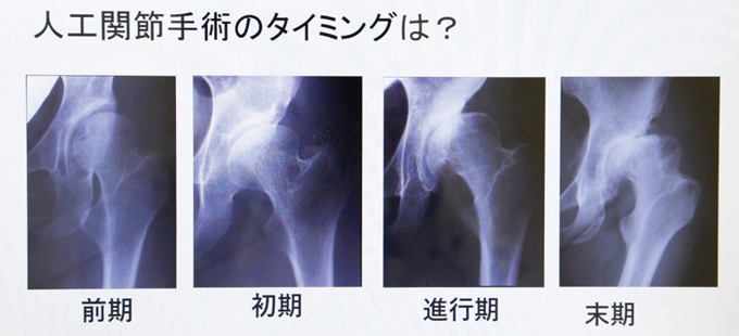 手術タイミングイメージ
