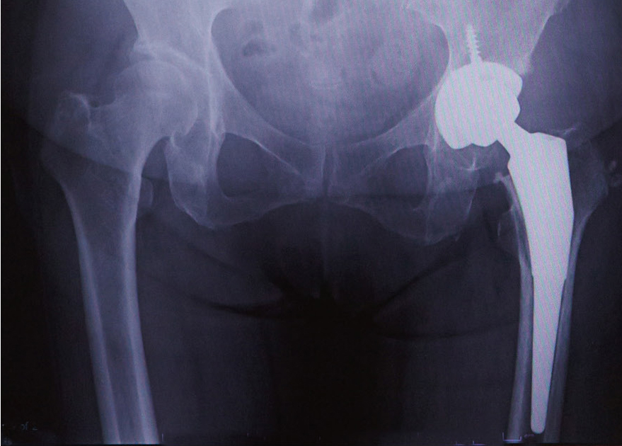 人工股関節置換術後のレントゲン