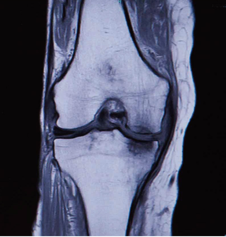 大腿骨内顆骨壊死のMRI