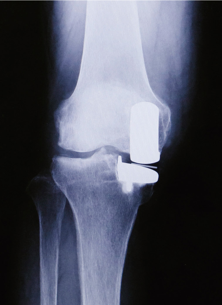 人工膝関節部分置換術後のレントゲン