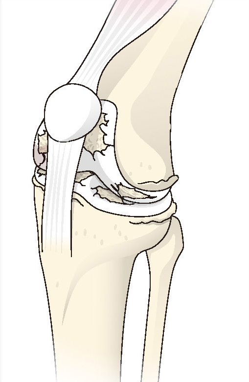 変形性膝関節症