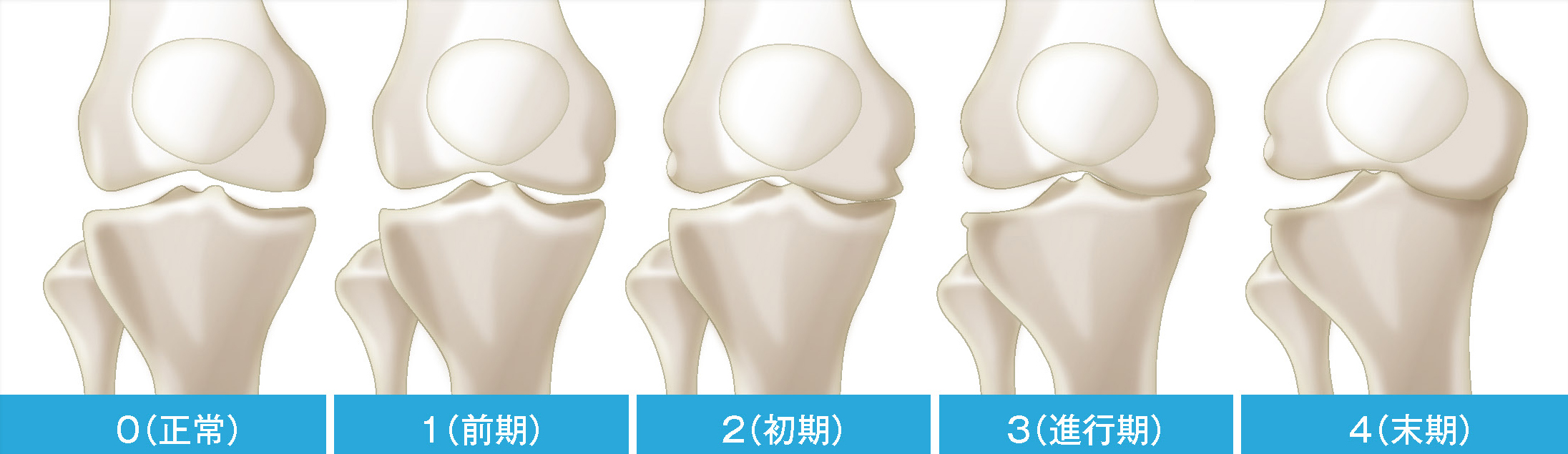 変形性膝関節症の5段階