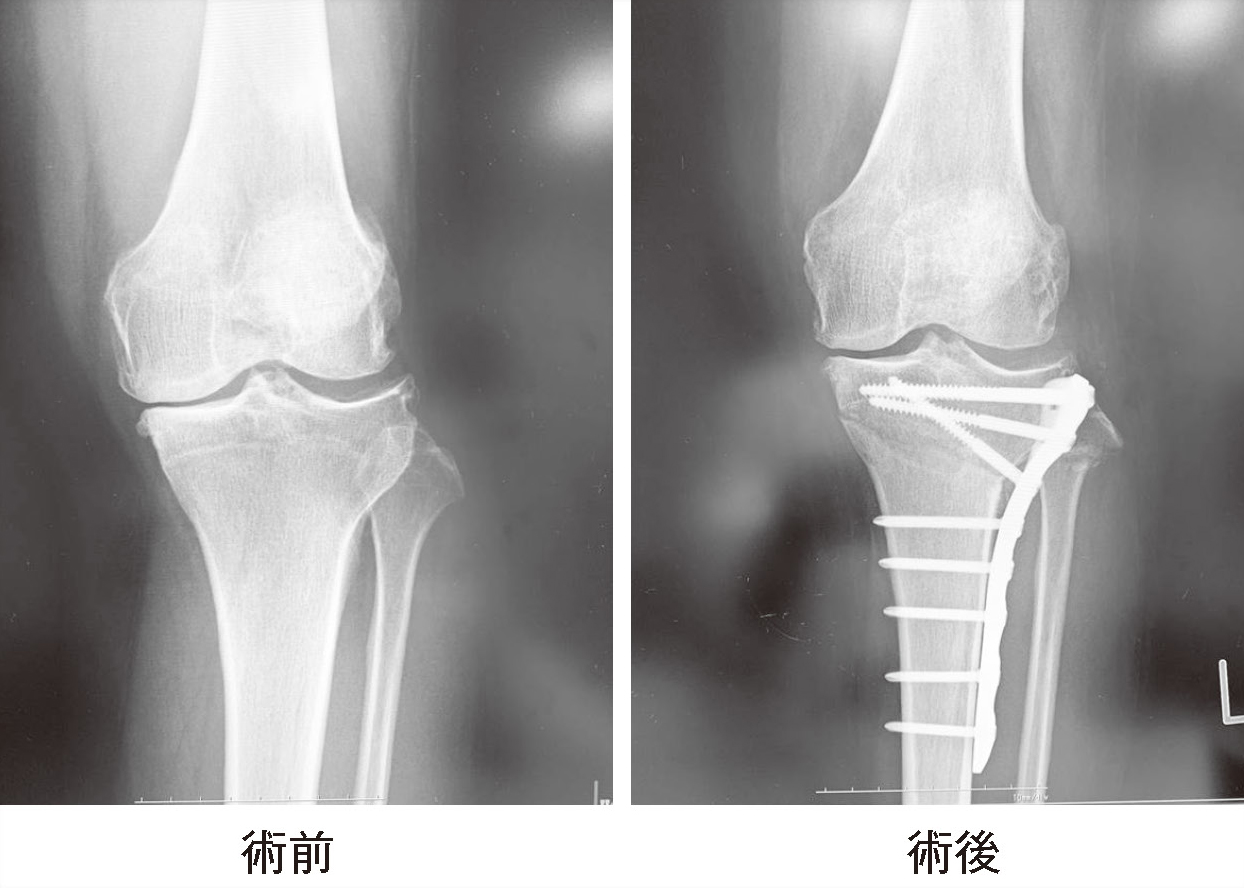 骨切り術