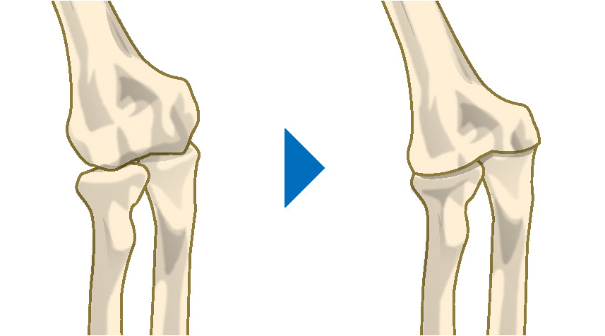 正常な肘関節と関節リウマチ等による変形した肘関節のイラスト