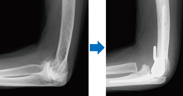 手術前のレントゲン→人工肘関節置換術後のレントゲン