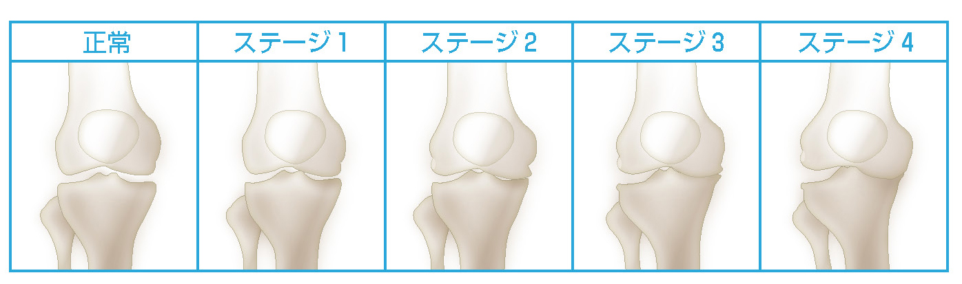 変形性膝関節症の分類