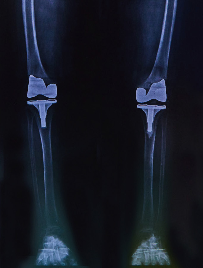 両膝同時手術後のレントゲン