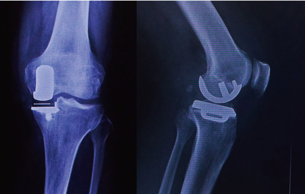 人工膝関節部分置換術後のレントゲン（正面と側面）