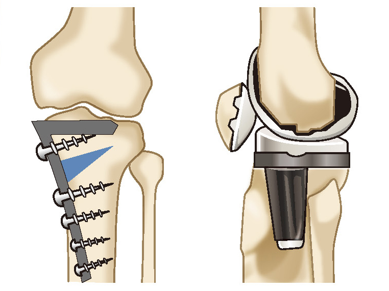 骨切り術と人工膝関節置換術