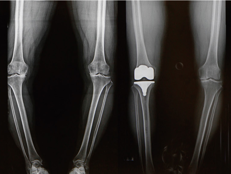 手術前と人工膝関節置換術後のレントゲン