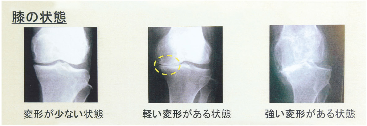 変形性膝関節症