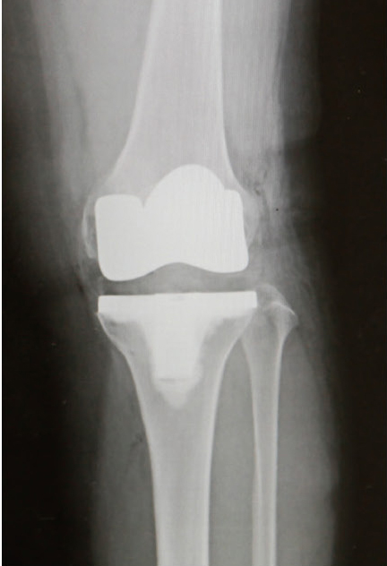 人工膝関節全置換術後のレントゲン