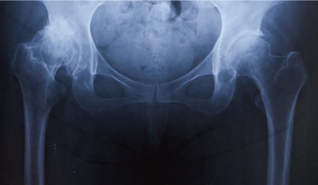 変形性股関節症のレントゲン