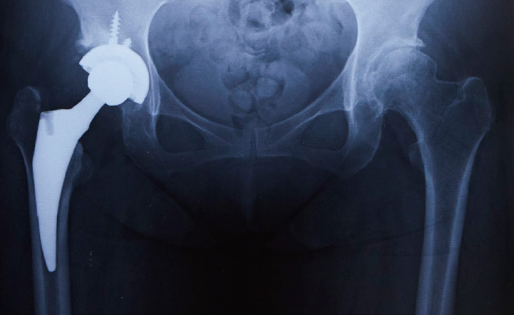 人工股関節置換術後のレントゲン