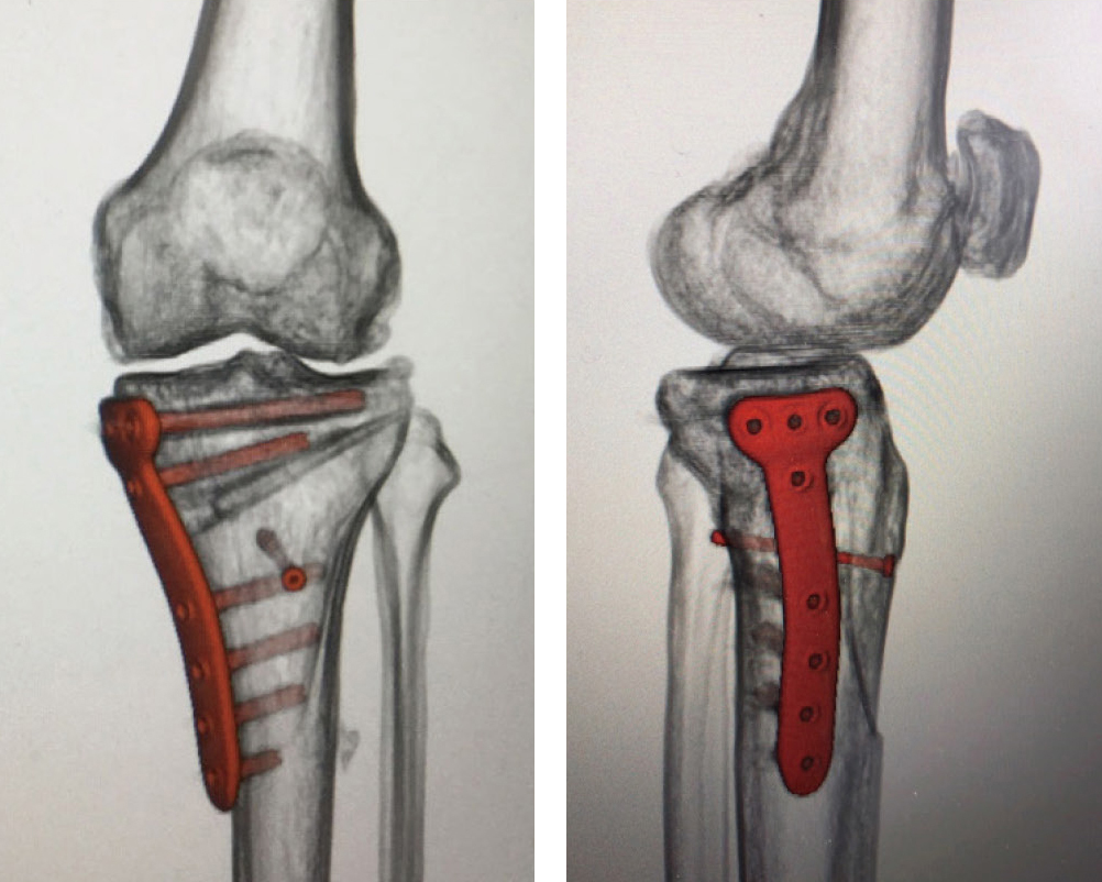 膝関節の骨切り術（正面と側面）