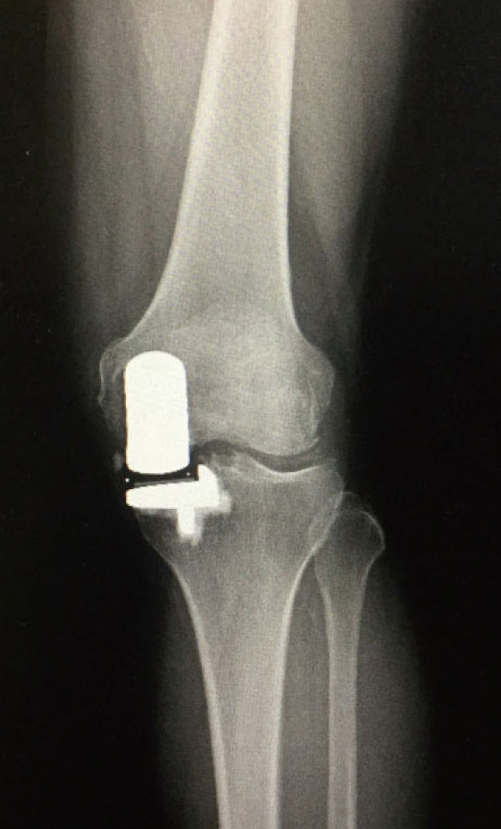 人工膝関節単顆置換後の
レントゲン