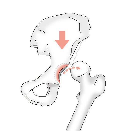 股関節脱臼