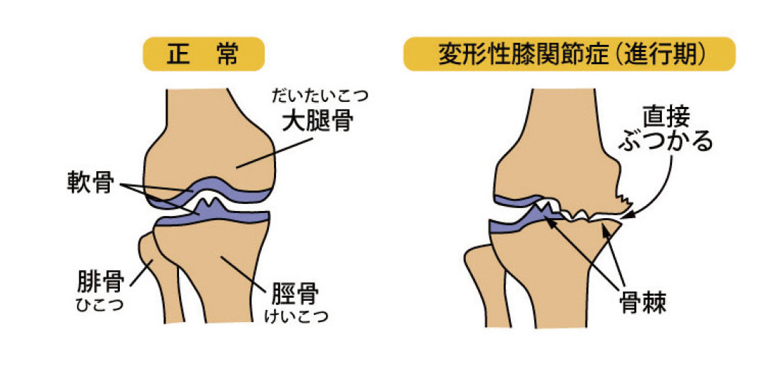 正常な状態と変形性膝関節症のイラスト