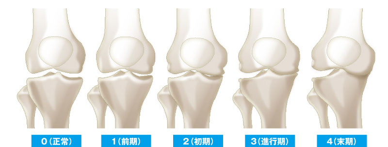 大森 敏規 先生 膝の痛みの原因と治療法 膝の痛みは年齢や活動レベルによってさまざま 膝に痛みがあれば整形外科の専門医に相談を 人工関節 ドットコム