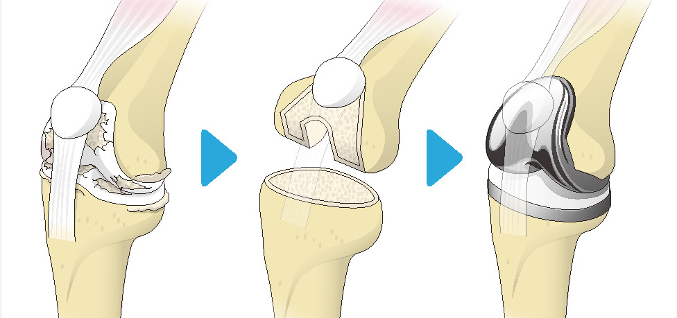 大森 敏規 先生 | 人工膝関節置換術の特徴 | 膝の痛みは年齢や活動レベルによってさまざま 膝に痛みがあれば整形外科の専門医に相談を
