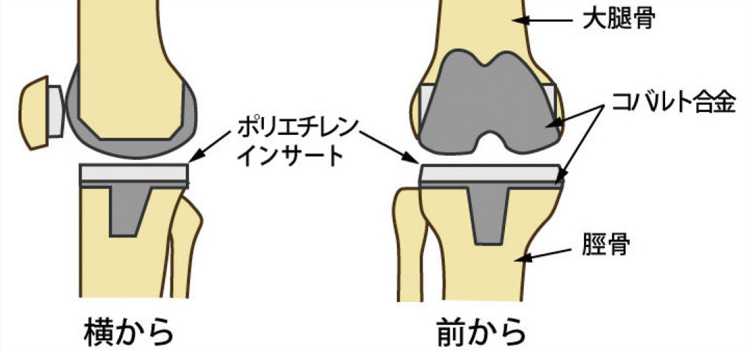 人工膝関節置換術後のレントゲン