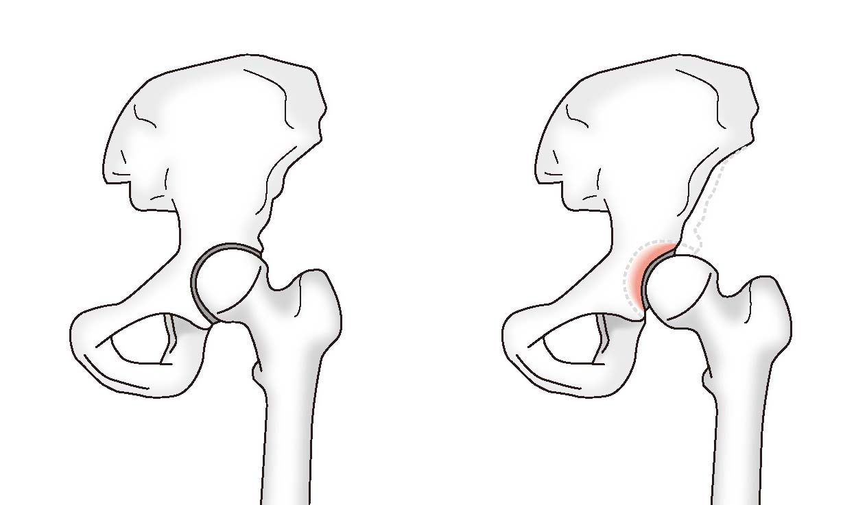 正常な股関節（左）と寛骨臼形成不全（右）