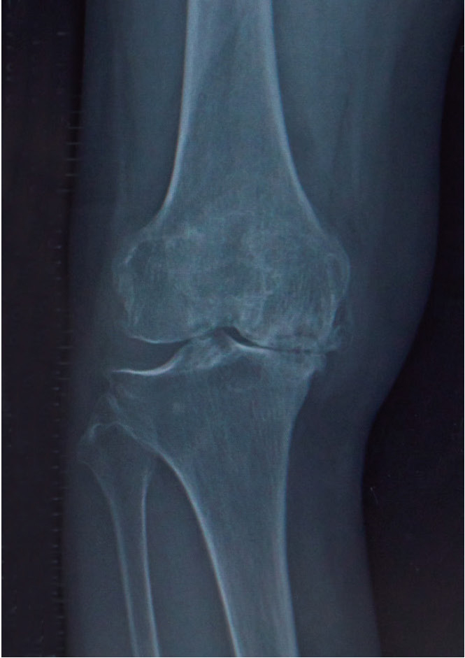 変形性膝関節症のレントゲン