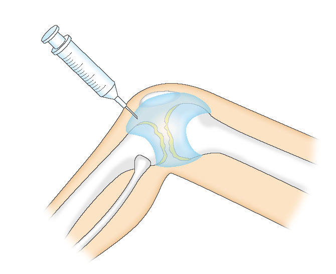膝関節内へのヒアルロン酸注射