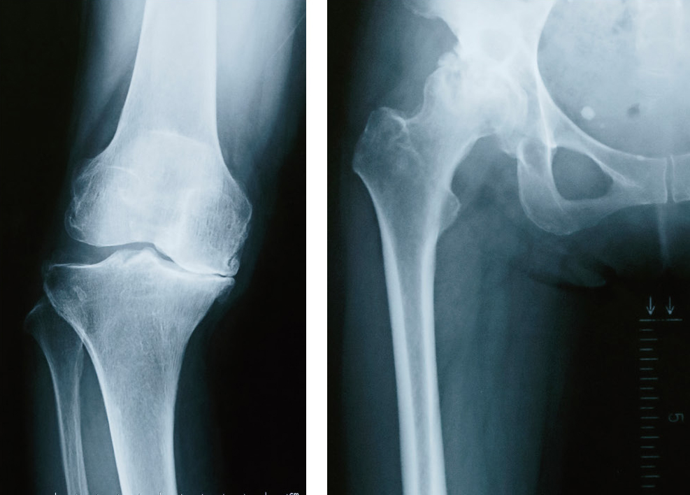 変形性膝関節症と変形性股関節症のレントゲン