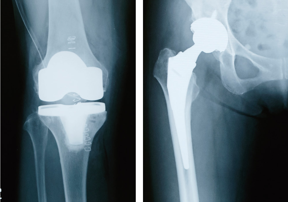 人工膝関節置換術後と人工股関節置換術後のレントゲン