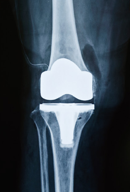 人工膝関節全置換術後のレントゲン
