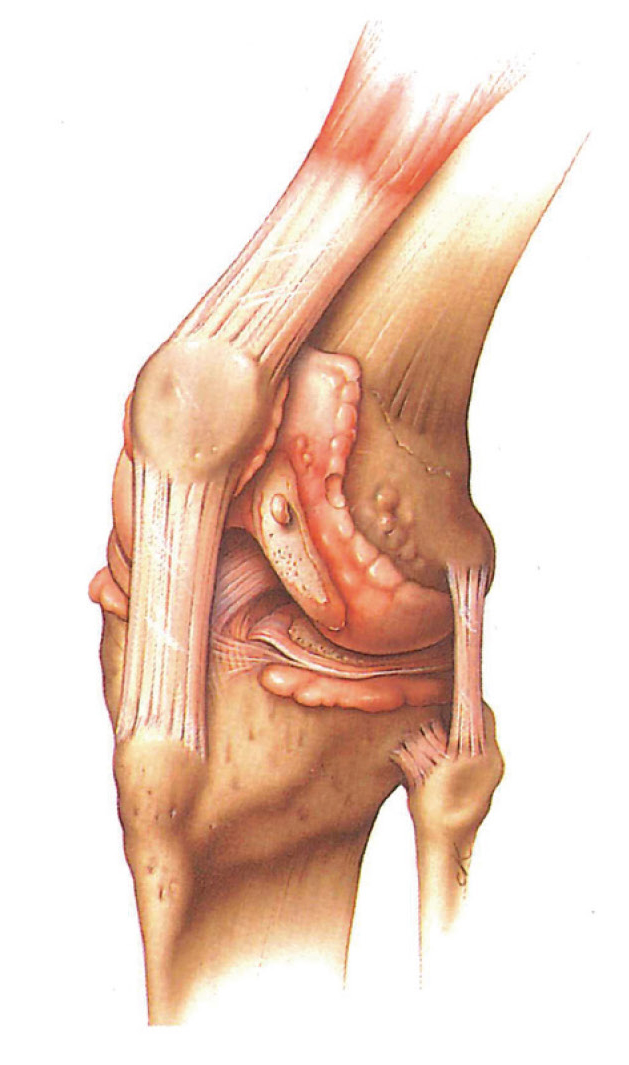 関節リウマチの膝関節