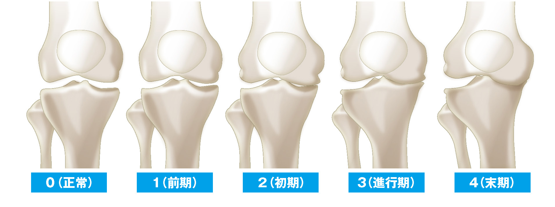 変形性膝関節症5段階