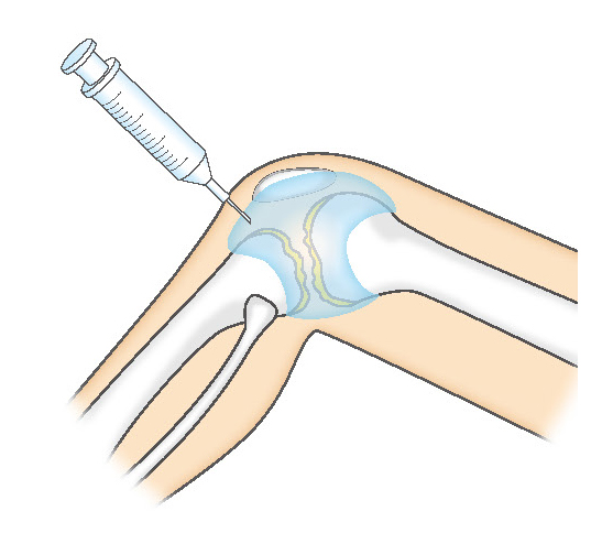 関節内へのヒアルロン酸注射