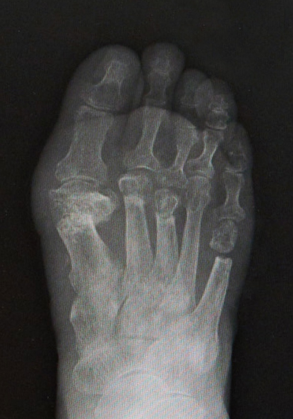 重度の外反母趾、足趾脱臼の手術後のレントゲン。アライメント（骨の並び）が整っています。