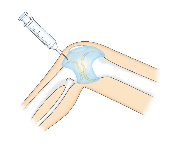 ヒアルロン酸の関節内注射
