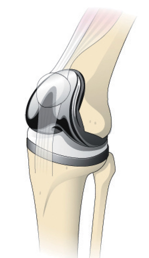 人工膝関節全置換術（虫歯治療のようなもの）