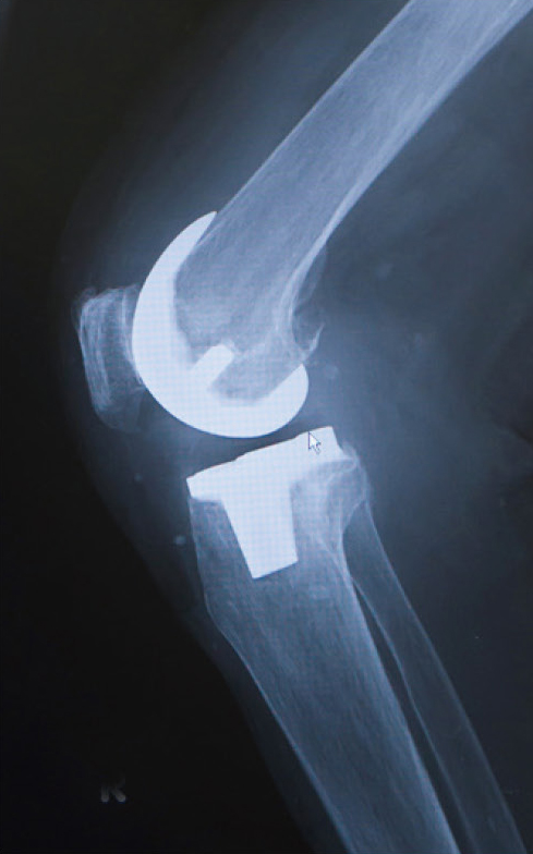 人工膝関節全置換術後のレントゲン（屈曲）