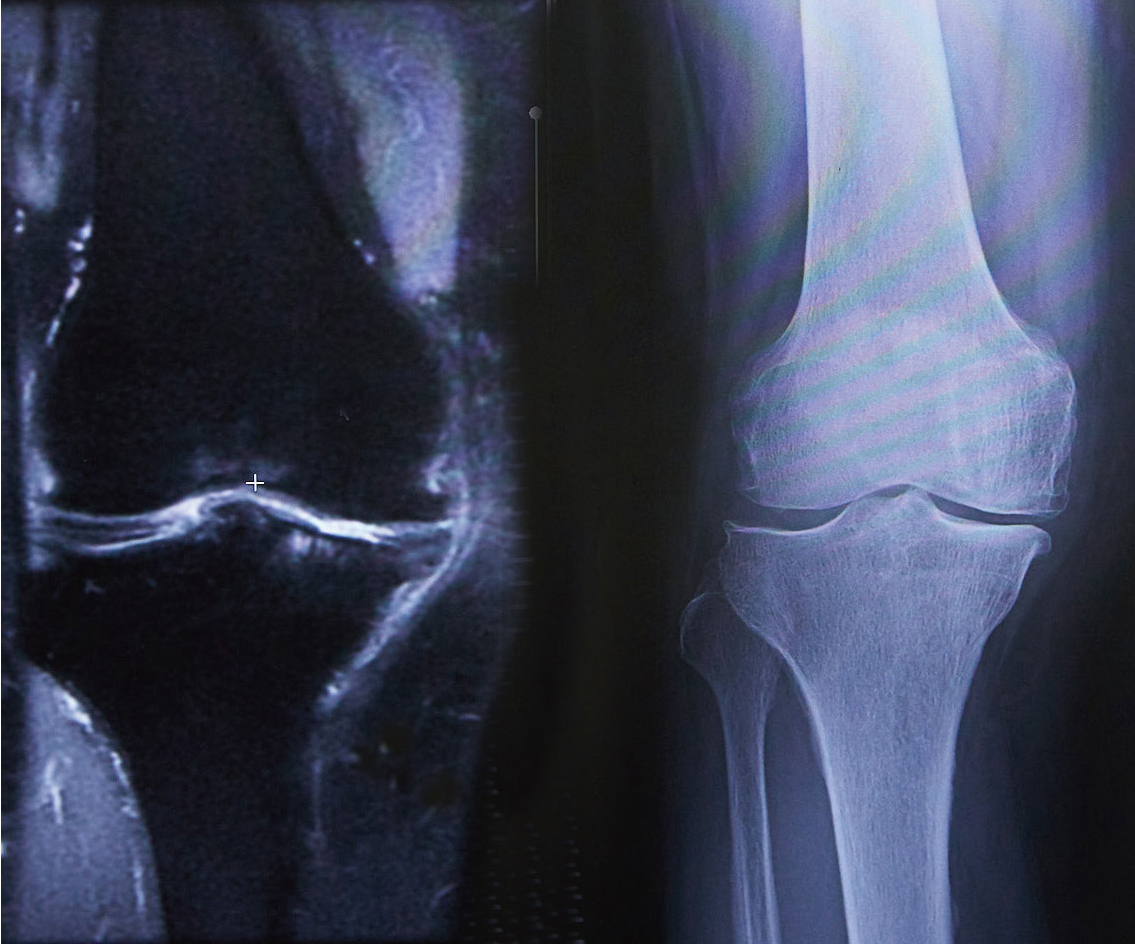 変形性膝関節症のMRI とレントゲン