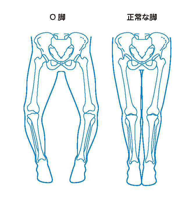 O脚と正常な脚